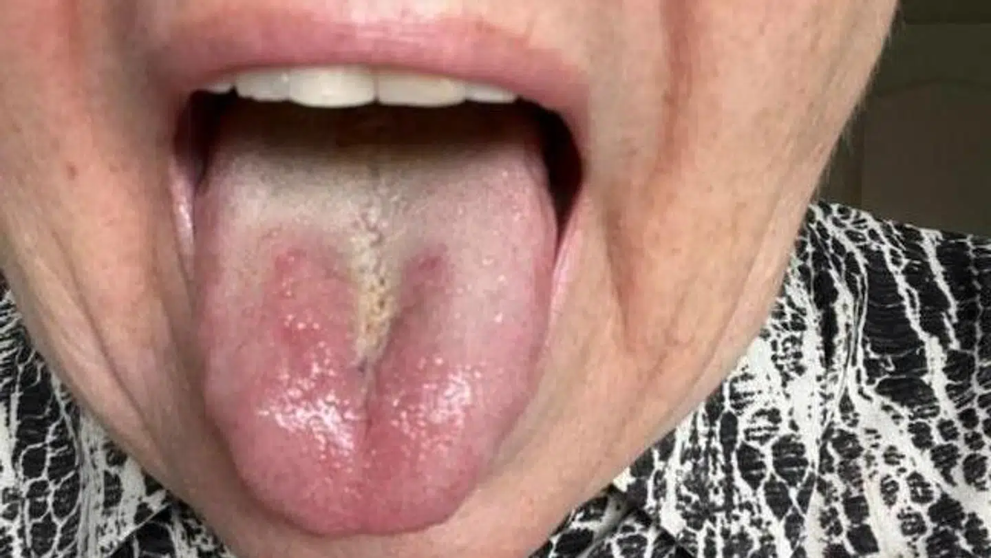 Sådan så Lesley Lauridsens tunge ud få uger efter hendes coronaforløb.