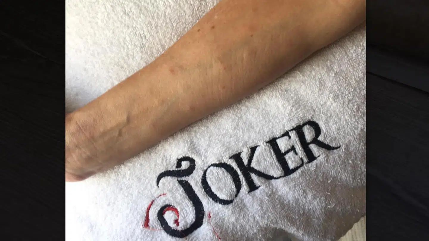 Linda Bladt har fået knopper på kroppen under opholdet på Joker Side Hill Suite Hotel.