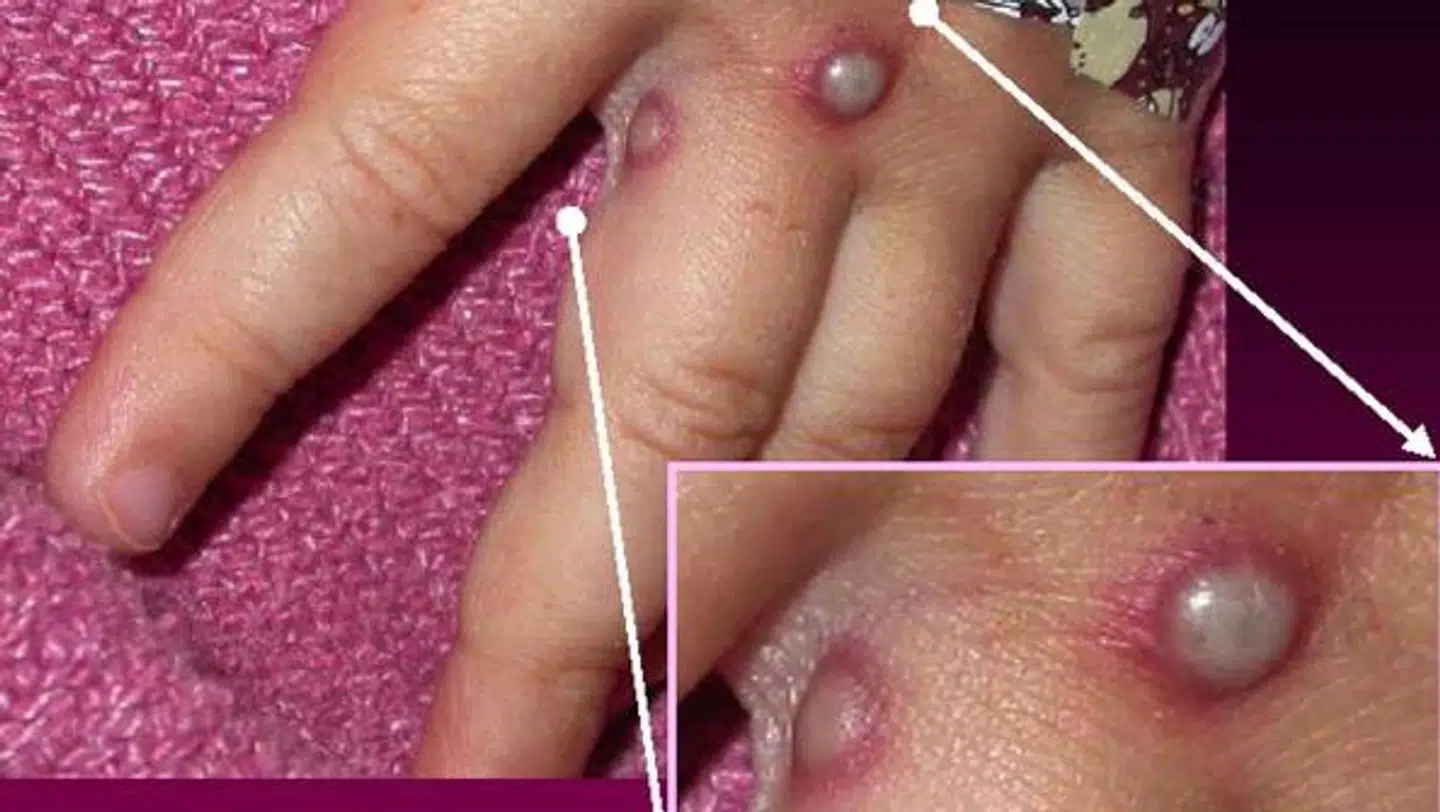 Abekopper er kommet til Danmark – nu melder en virksomhed sig ind i kampen mod virusset.