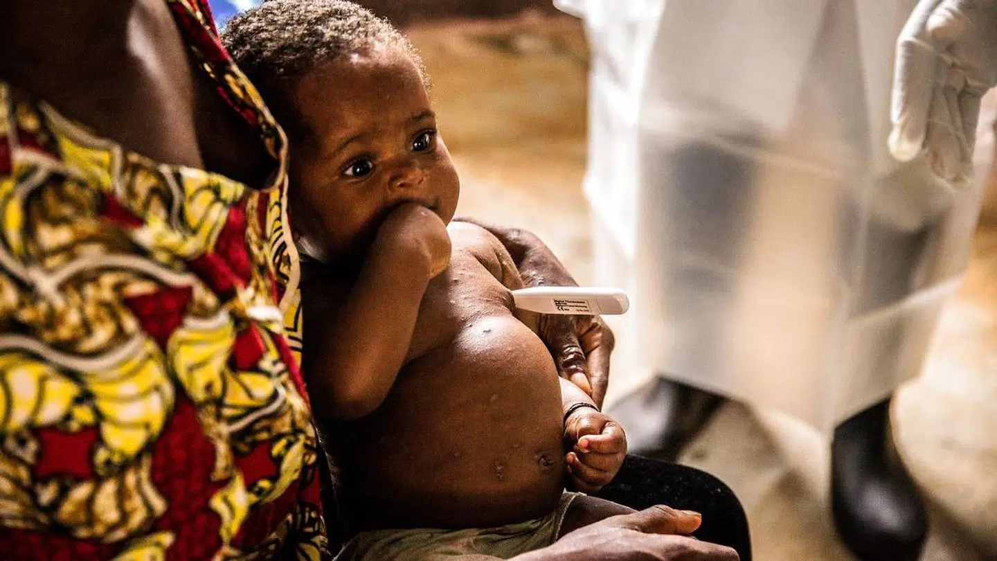 Et lille nigeriansk barn med abekopper.