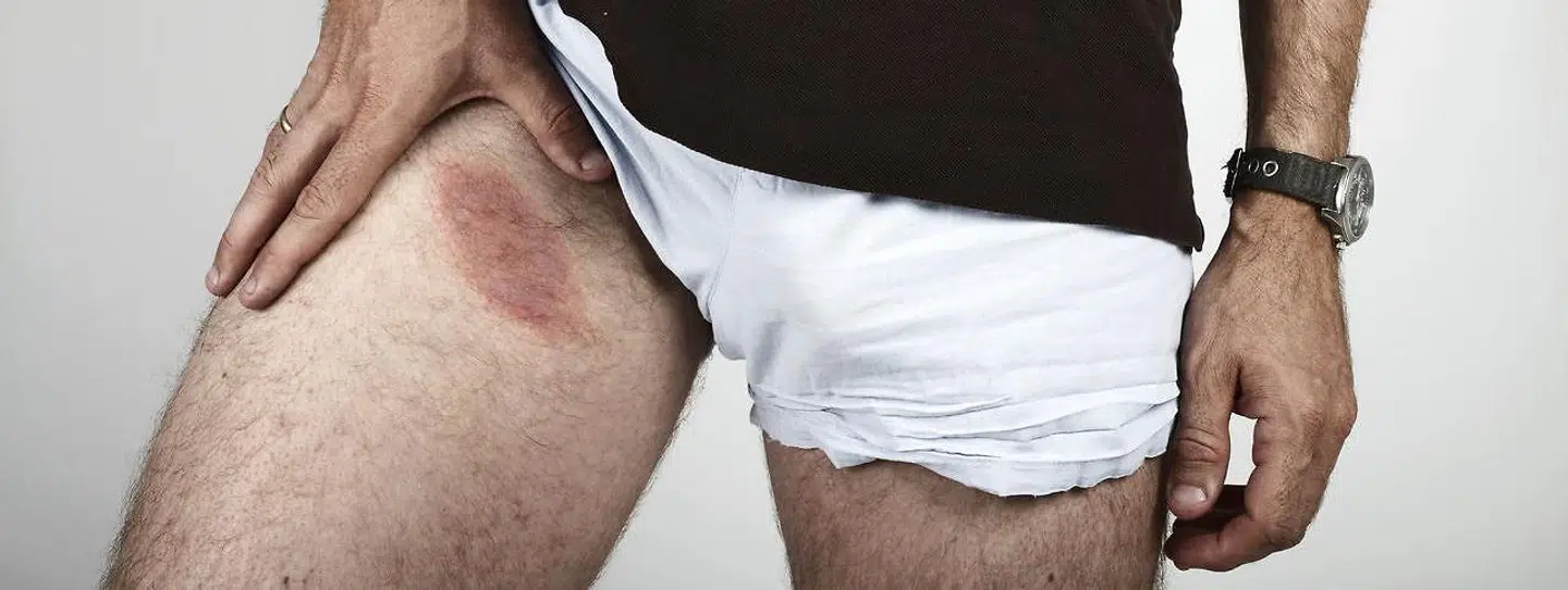 Billede af skader ni dage efter bid fra skovflåt. Der kom først udslæt efter syv dage, så mærket er kun to dage gammelt. Borrelia.