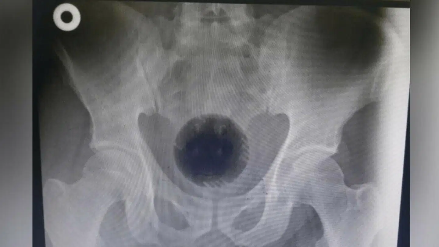 Foto: International Journal of Surgery Case Reports