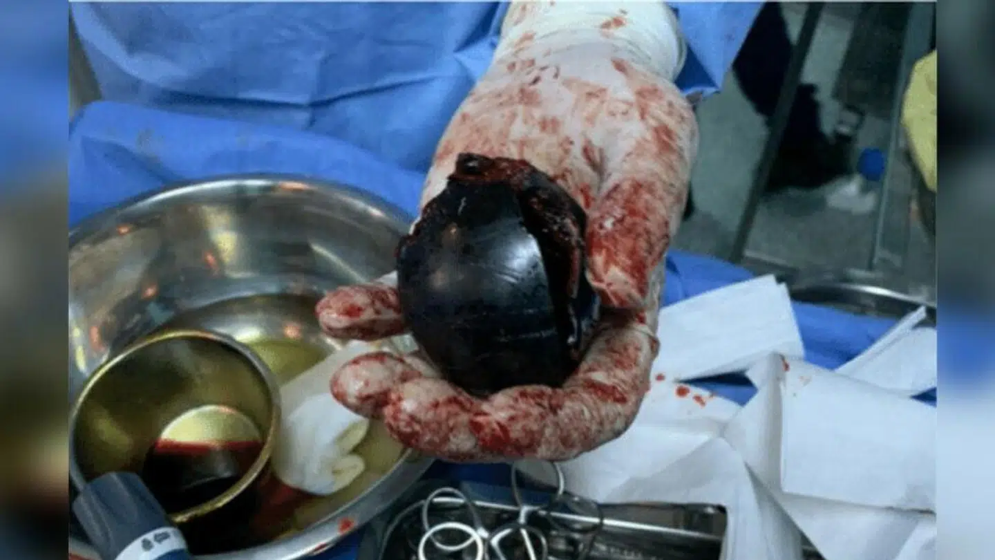 Efter en større operation lykkedes det lægerne at få platikkuglen ud af mandens anus. Foto: International Journal of Surgery Case Reports