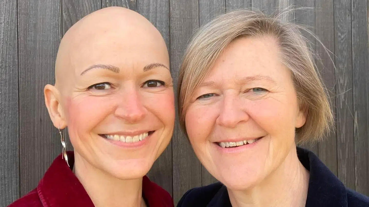 Camilla Valsten er én af de mellem 5.000-10.000 danskere, der har sygdommen alopecia.