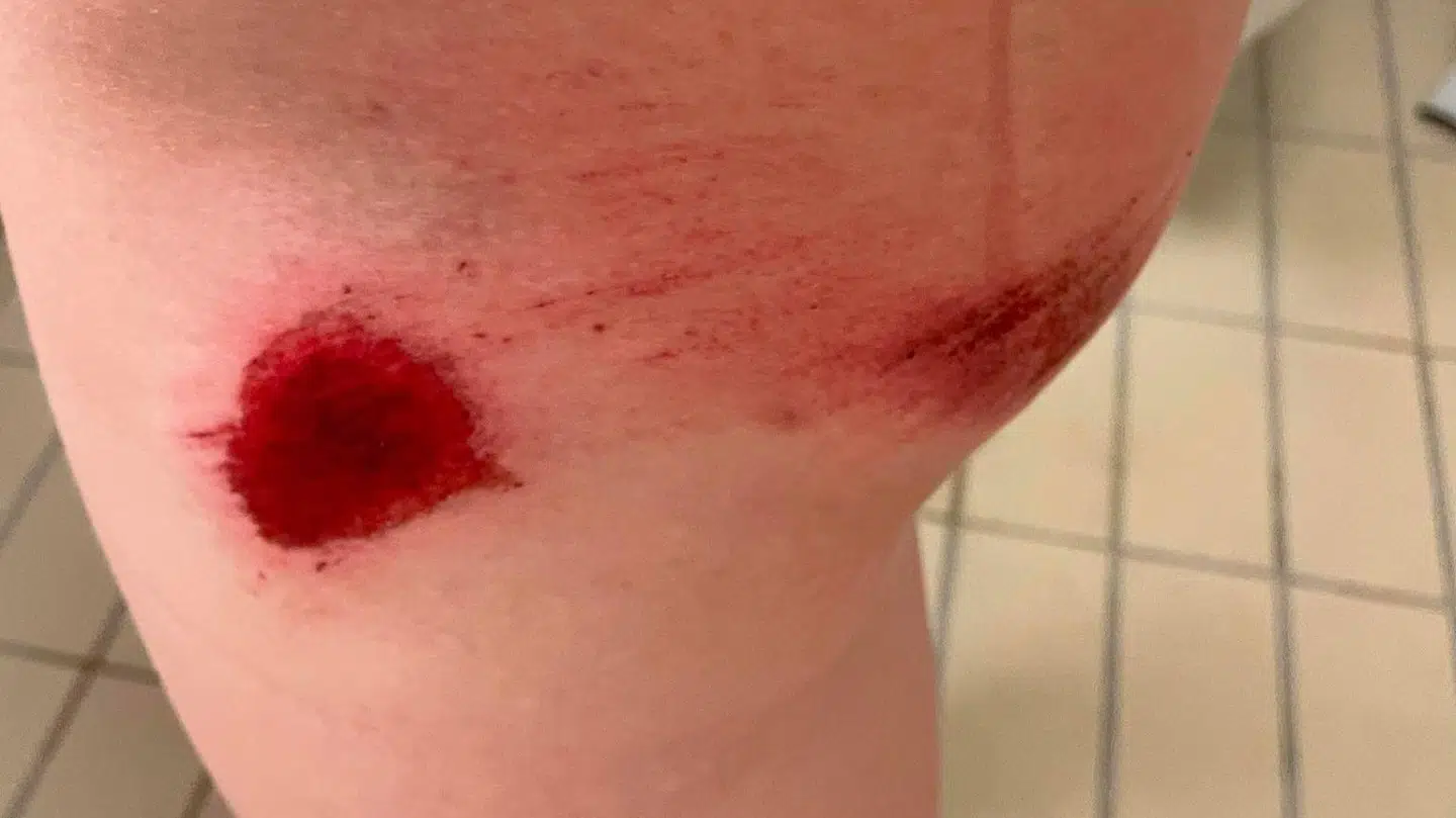 Den 17-årige rytter, som onsdag blev ramt af en bil på en træningstur, er godt forslået.