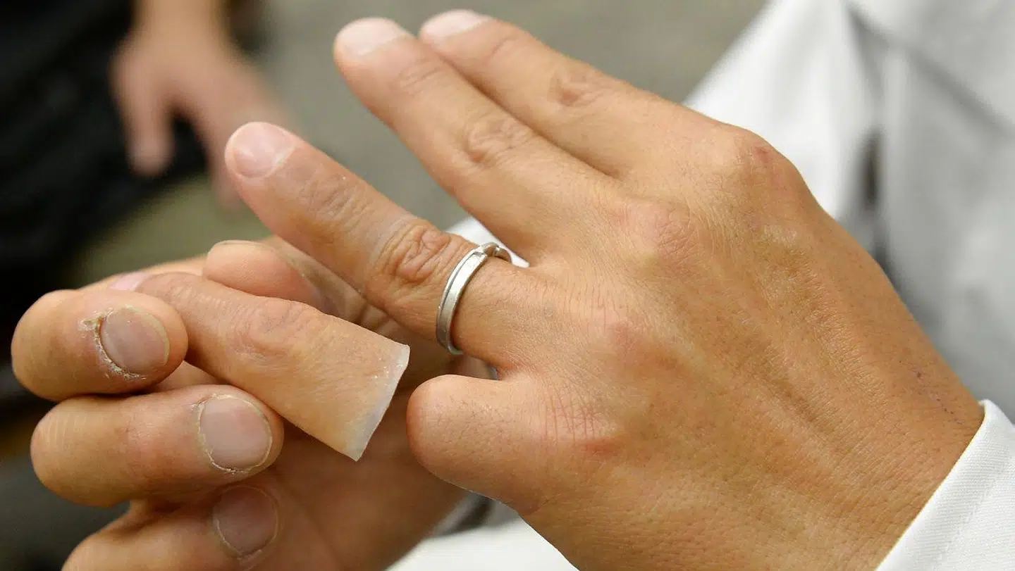 Arkivfoto: Et af Yakuzaens mere kuriøse ritualer kaldes yubitsume. Her kan et medlem betale en gæld ved at skære et led af lillefingeren. Det sker uden hjælp fra andre. På billedet ses et Yakuza-medlem ved en protesehandler, da han har valgt at forlade den kriminelle underverden.