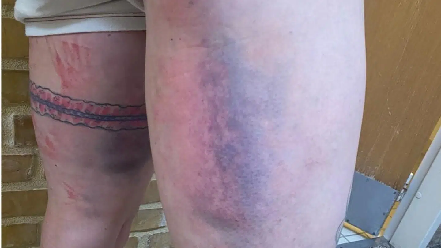 Lisbeth Østergaard viser de blå ben frem på sin Instagram.