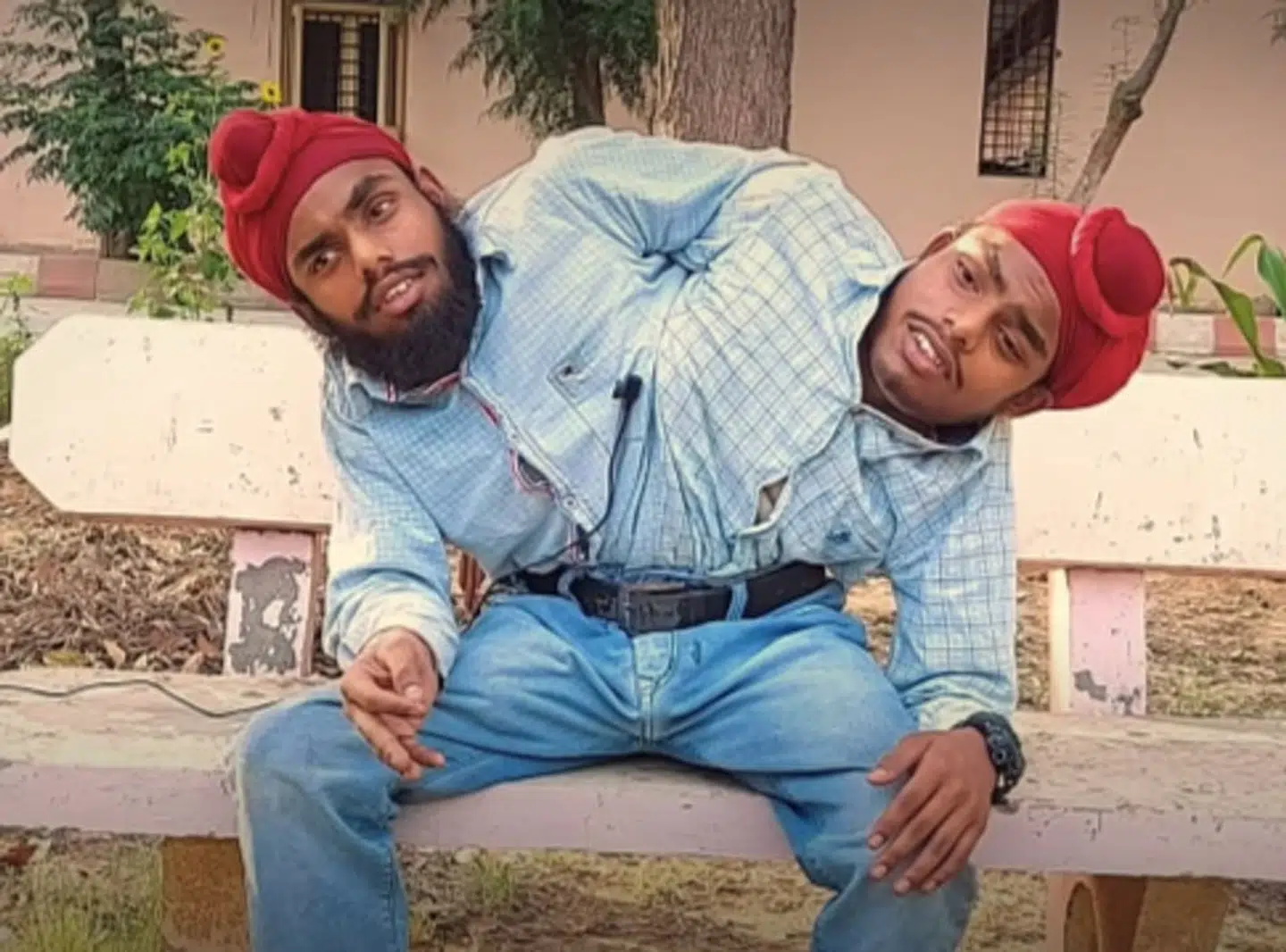 De siamesiske tvillinger Sohna og Mohna Singh fra Amritsar i Indien er nu også blevet tætte kolleger.