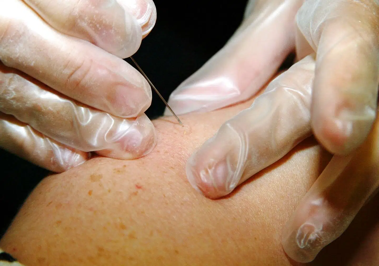 Vaccinen foregik på den måde, at man med en nål nærmest ridsede væsken ind i kroppen.