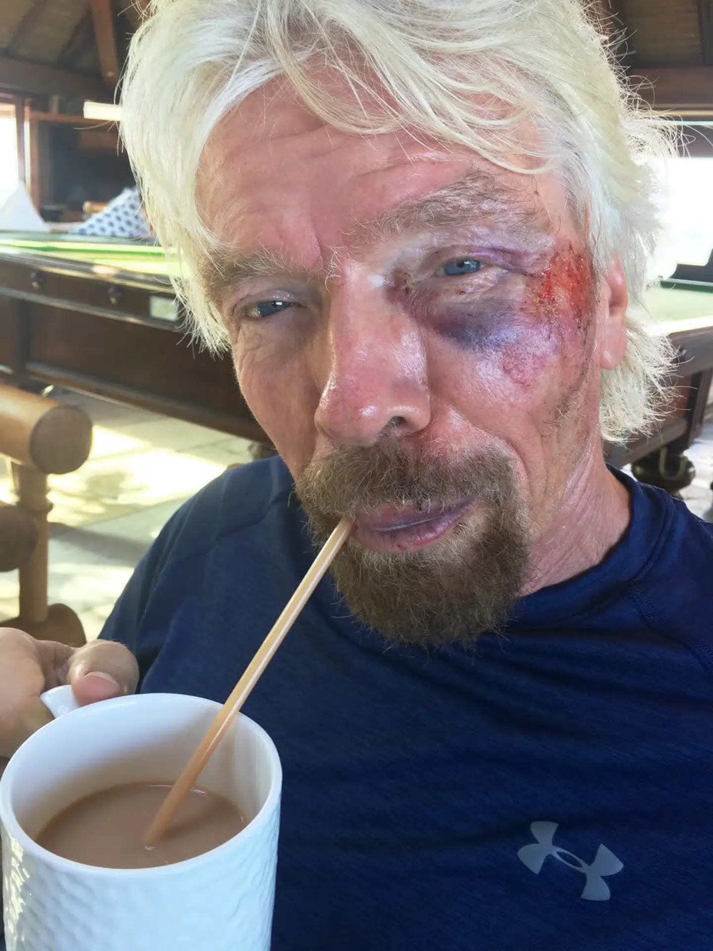 Richard Branson efter sin voldsomme cykelulykke. Foto: Virgin
