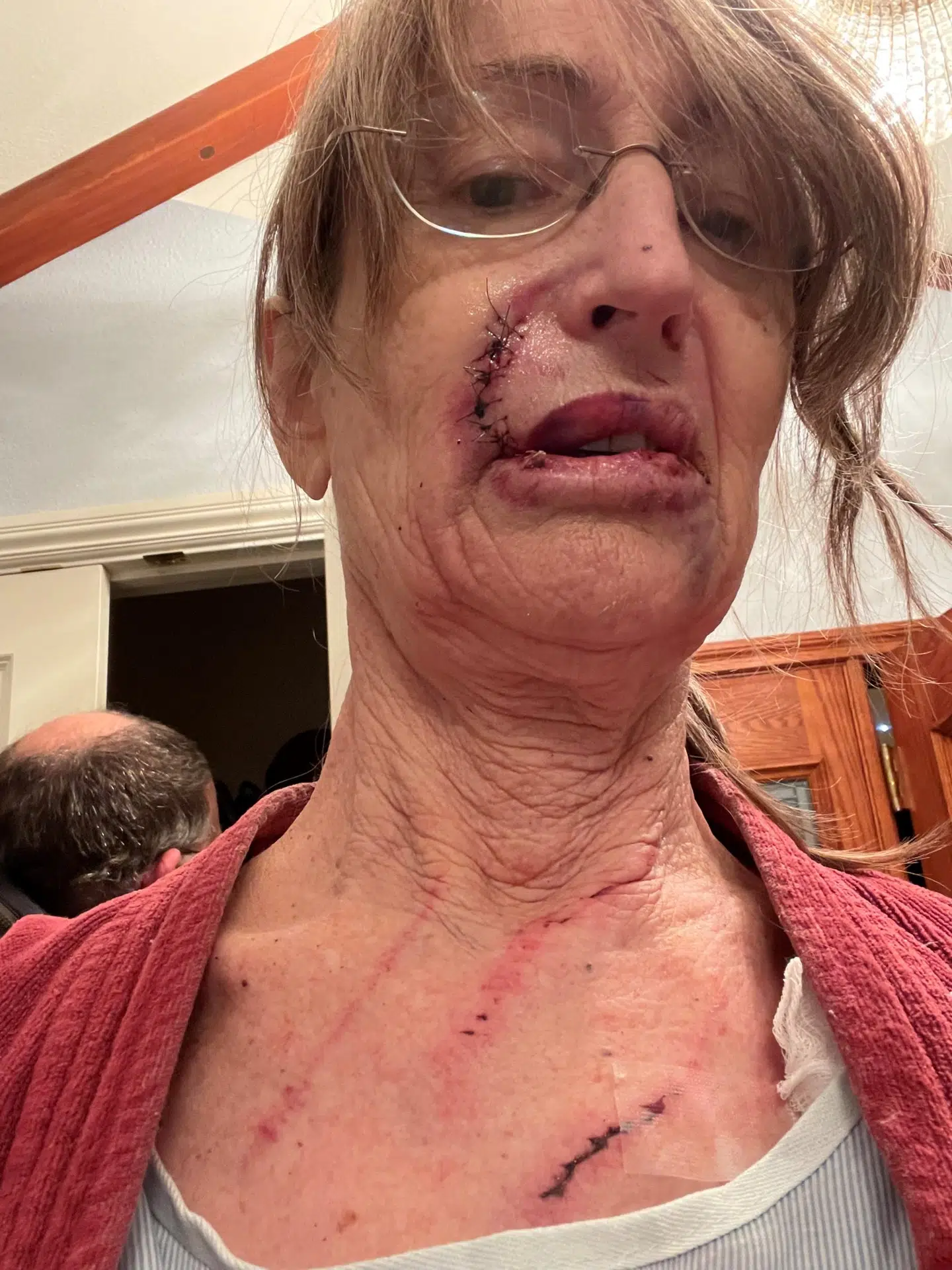 Sådan ser Laurel-Rose von Hoffmann-Curzi ud efter mødet med sortbjørnen.