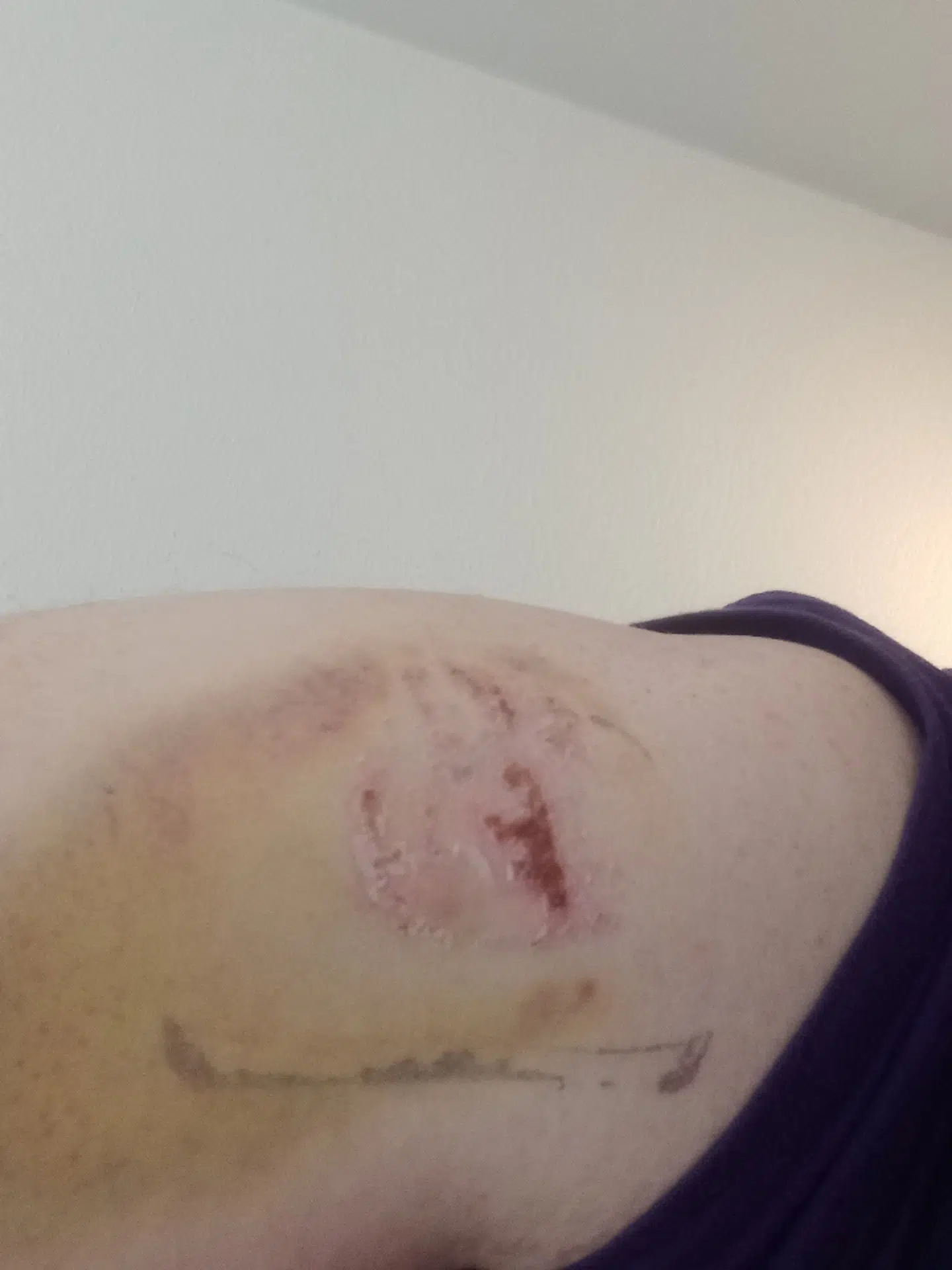 Bidemærket på Jesper Pedersens overarm.