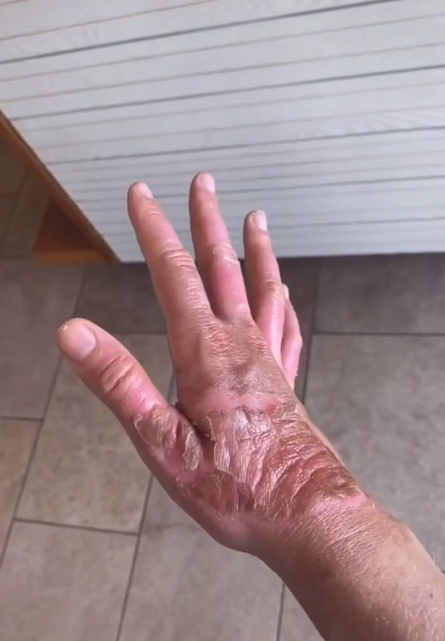 Allana Davisons forbrændinger var forårsaget af 'fytofotodermatitis'.