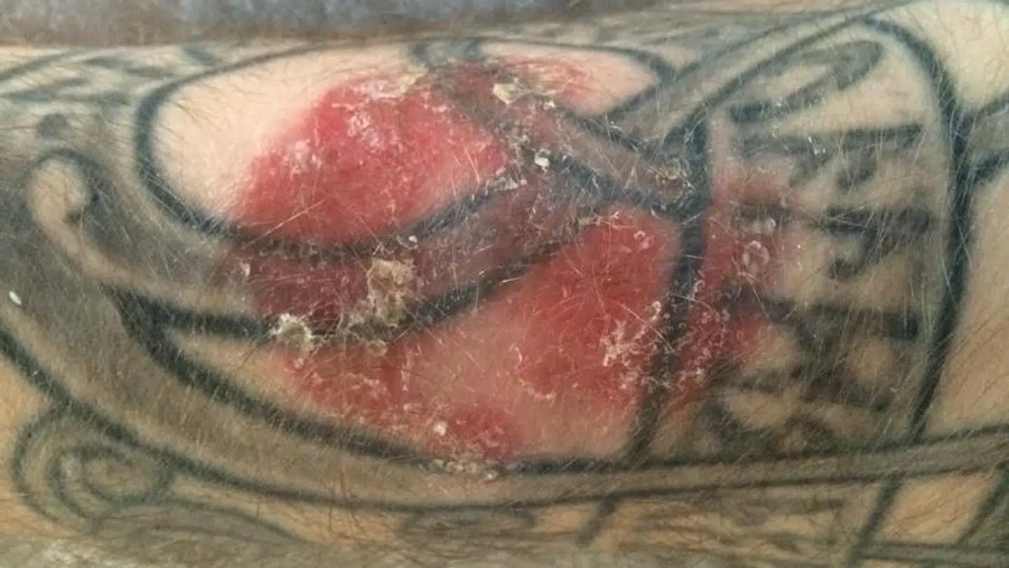 Søren har taget ganske få fotos af sin psoriasis. Her er det et billede af hans arm. Foto: Privat.