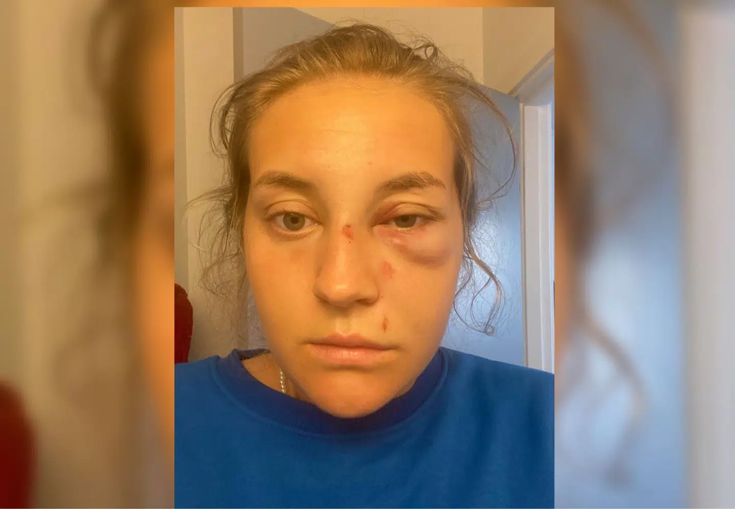 Annika Fredenslund er forarget over, at hun intet har hørt fra rejseselskabet Detur efter at have været involveret i en voldsom ulykke i Tyrkiet.