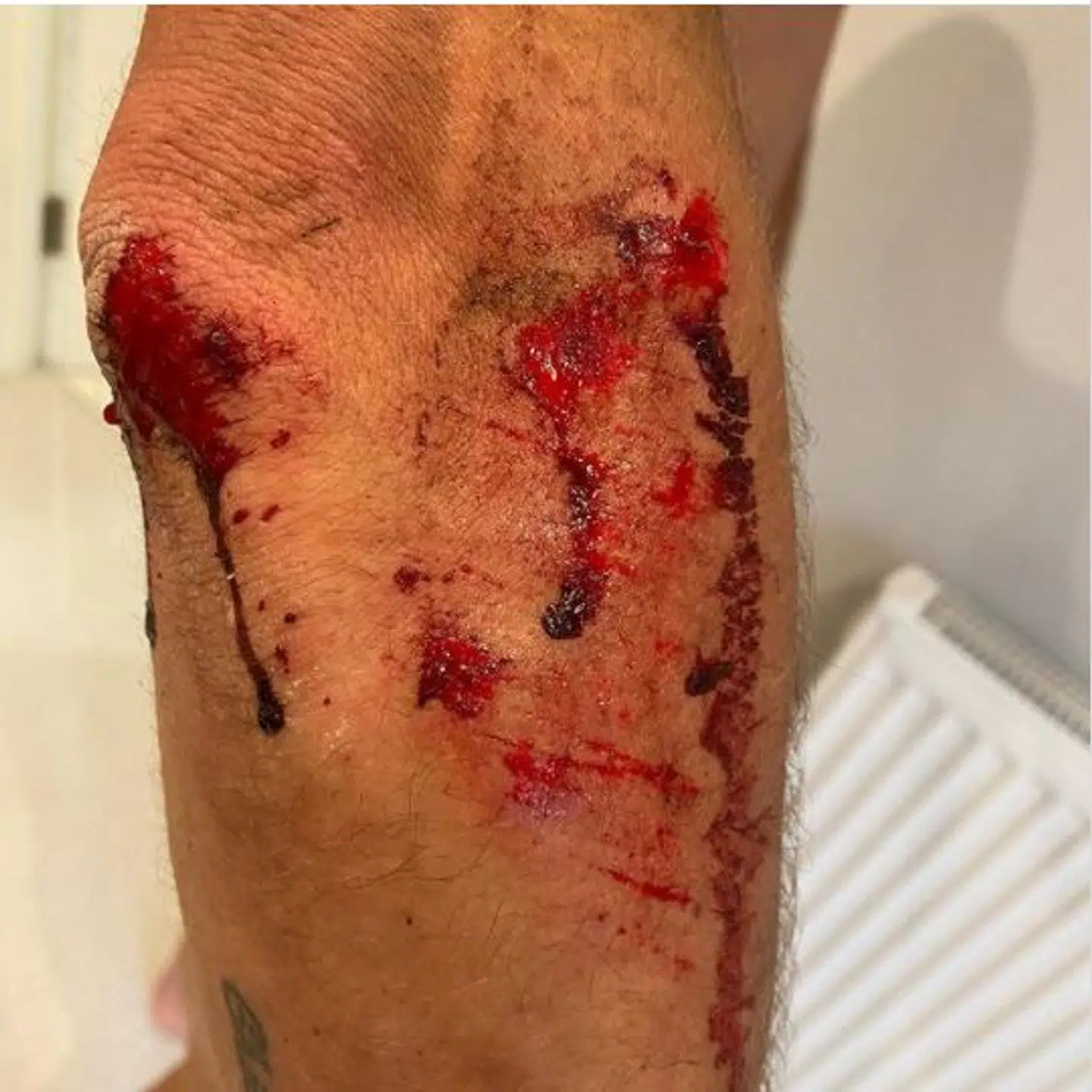 Alexandar Richardson slap fra overfaldet med livet i behold, men endte med et opskåret knæ og en hævet hofte. Foto: Alexandar Richardson/Instagram