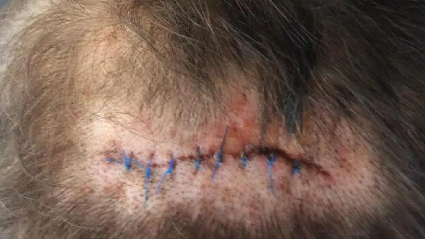 Arret i Allan Jensens kranie, efter det flækkede.