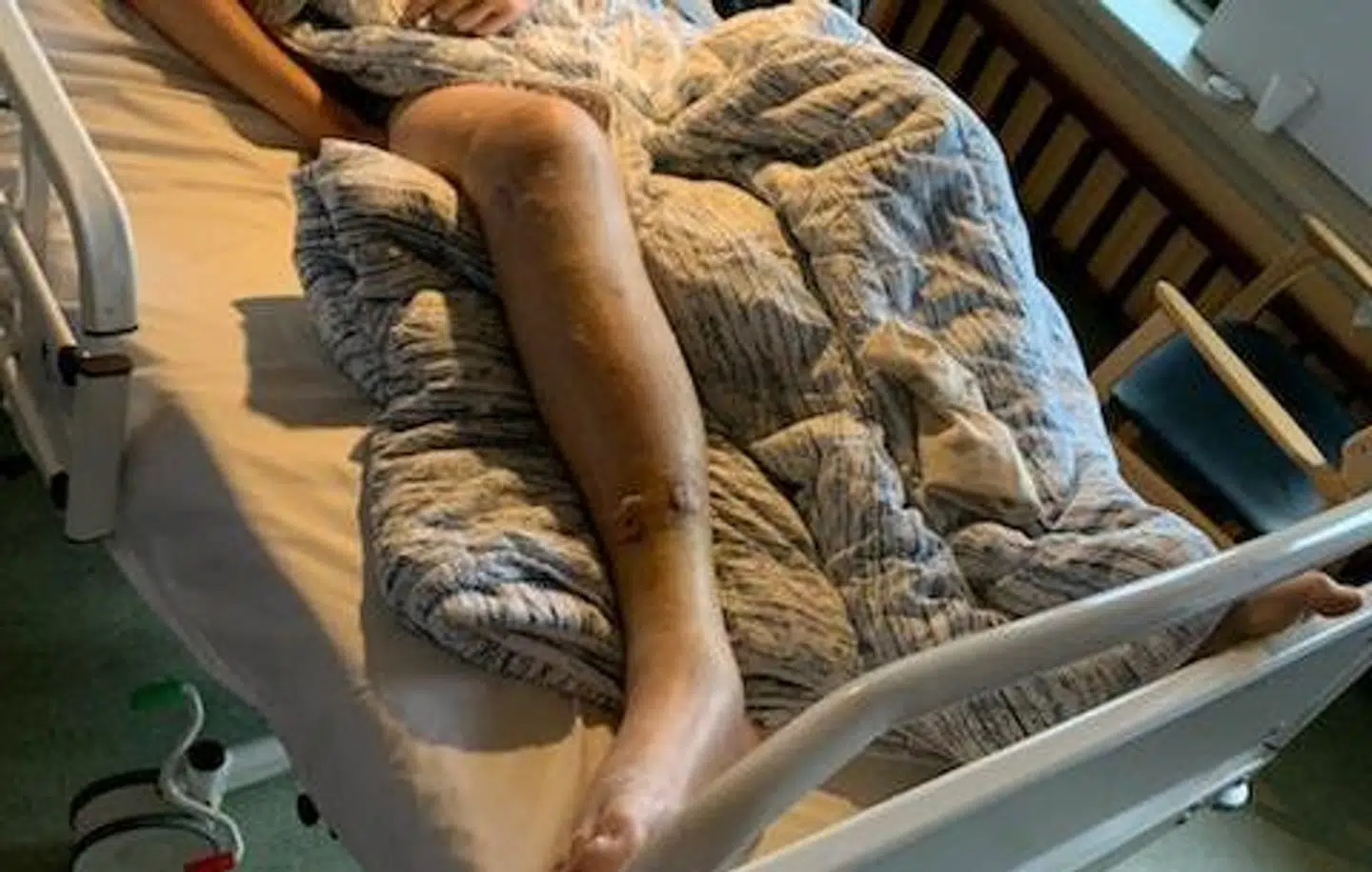 Sådan så Mathias Norsgaards ben ud inden den første operation.