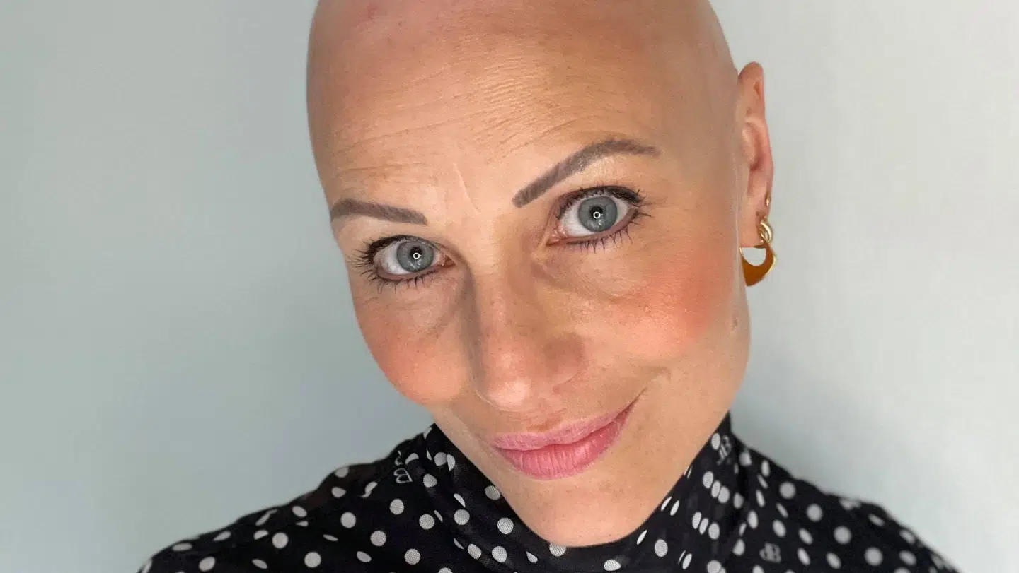 Herit Helgadóttir var 25 år, da hun tabte håret. Først bemærkede hun bare lidt skaldede pletter, men i løbet af et års tid håret væk. I dag har hun stort set kun øjenvipper tilbage.