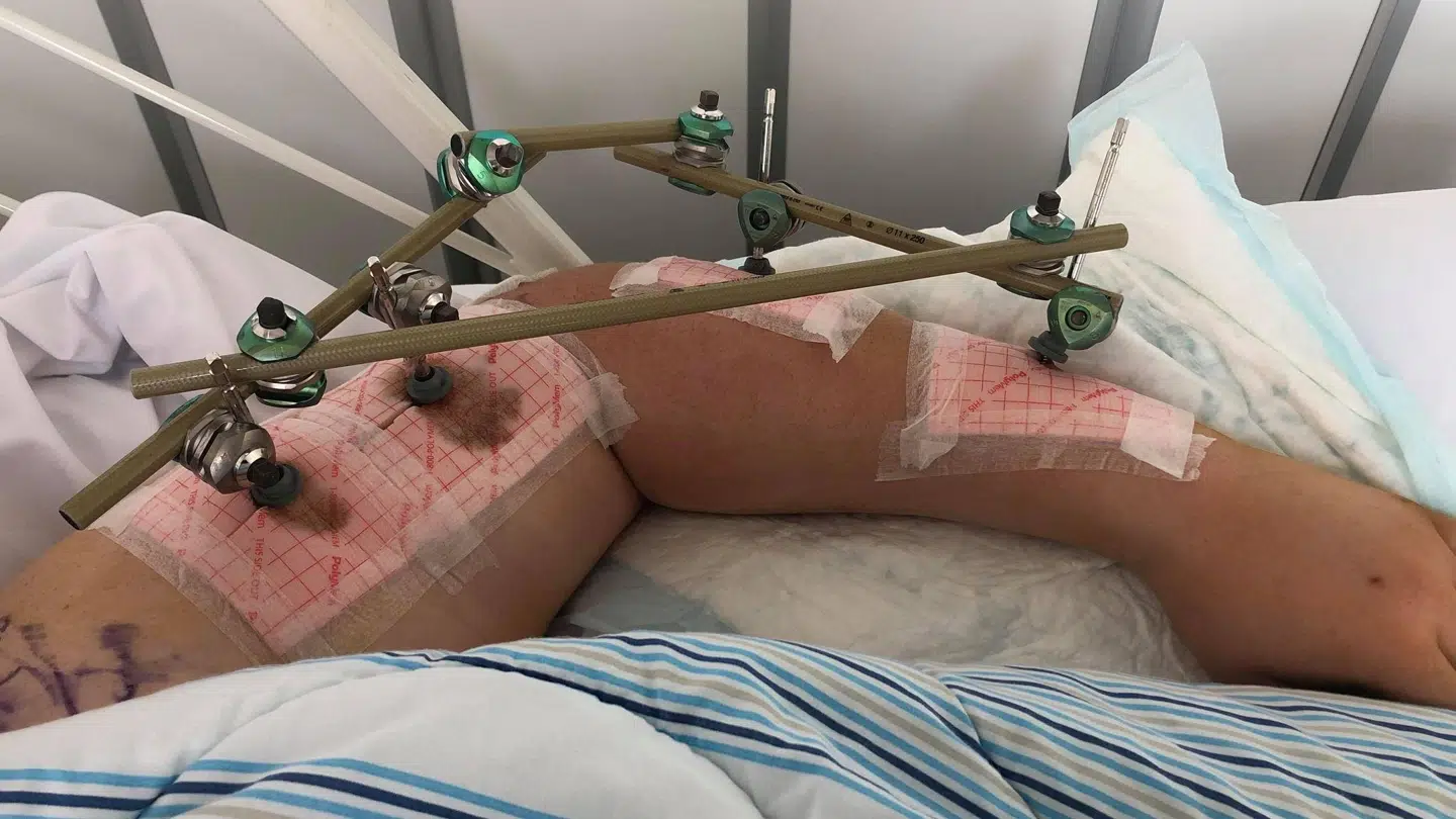 Styrtet resulterede i et åbent brud på venstre overarm og en knust albue.