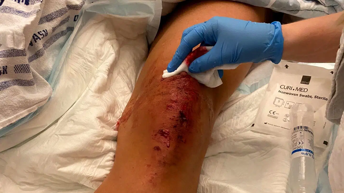 Søren Christensen fra DR-dokumentaren får en flænge i benet efter et cykelstyrt. Han rammes efterfølgende af kraftige smerter, der viser sig at være en kødædende bakterie. Han dør, fordi lægerne ikke i tide reagerer på de symptomer, han får. Foto: Privat.