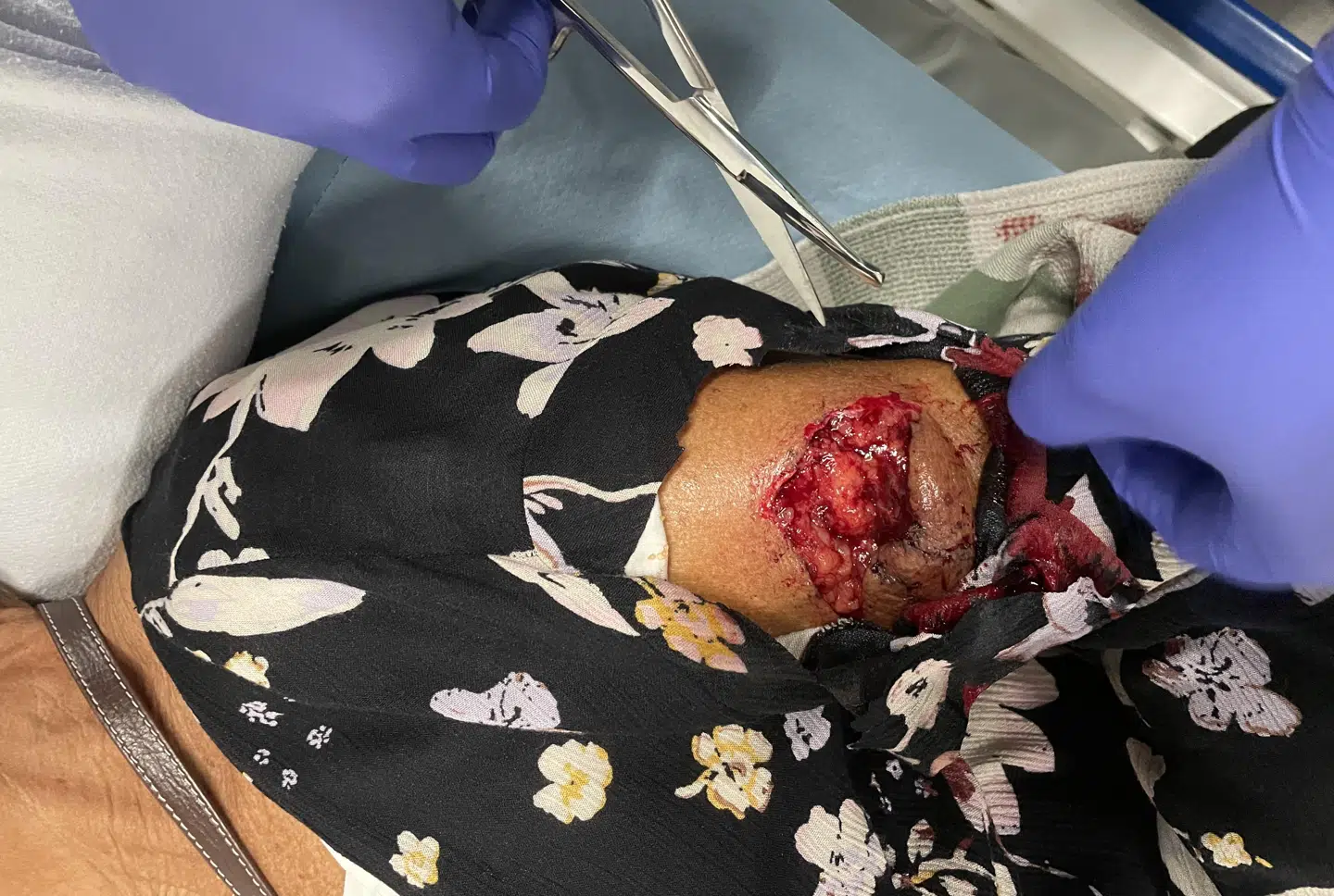 Sådan så Alices arm ud, efter hun 30. august blev bidt af en hund, da hun gik tur på Risbjerg Kirkegård i Hvidovre.
