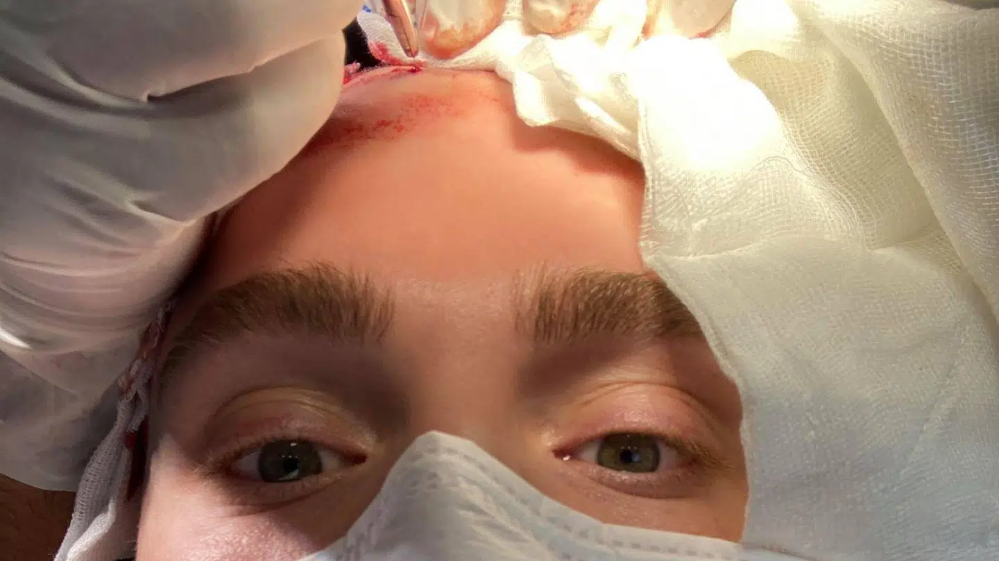 Daniel Guldberg under en hårtransplantation.