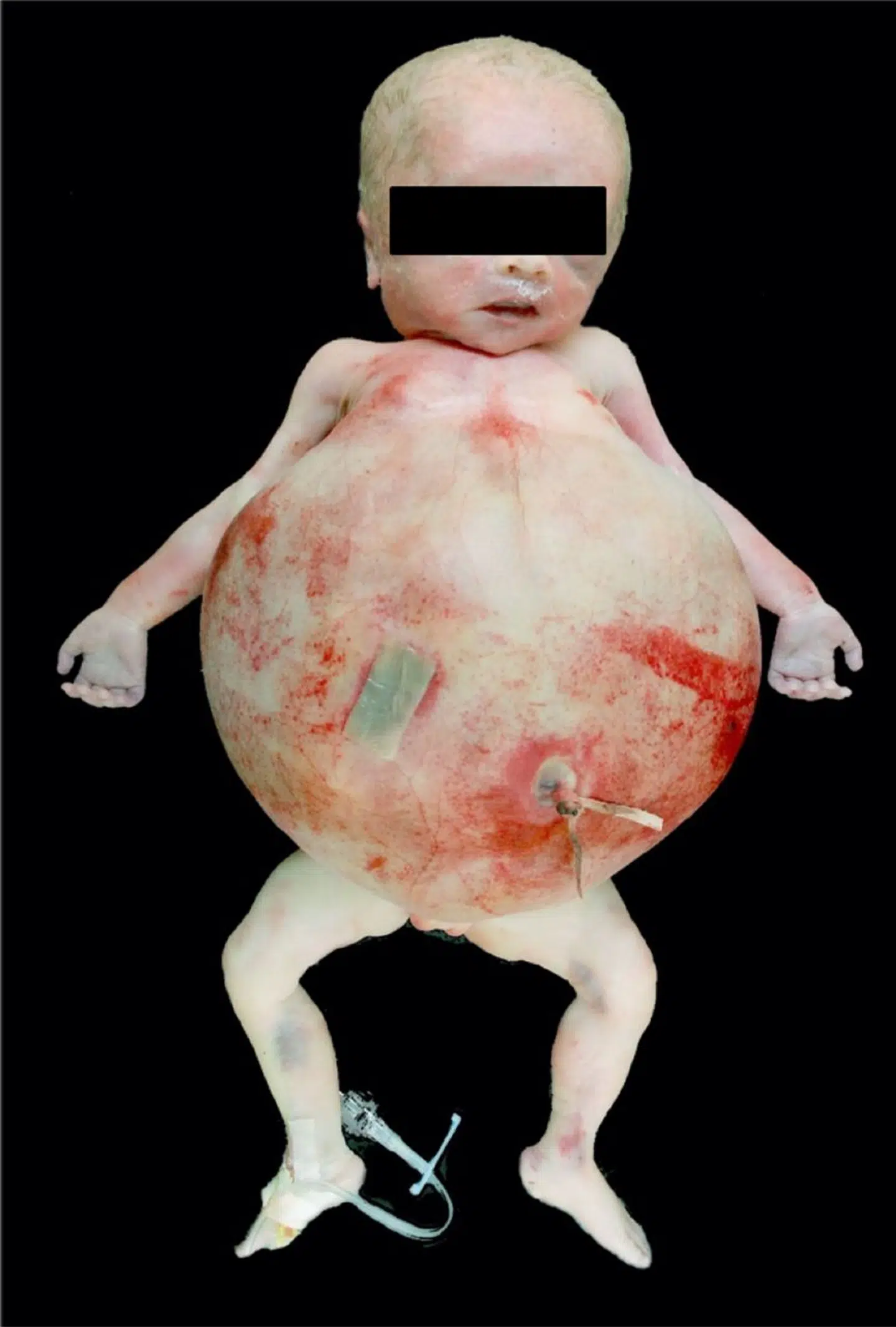 Amerikanske forskere beskrev i 2018 et fatalt tilfælde af fetus-in-fetu. Billeder stammer fra deres udgivelse.