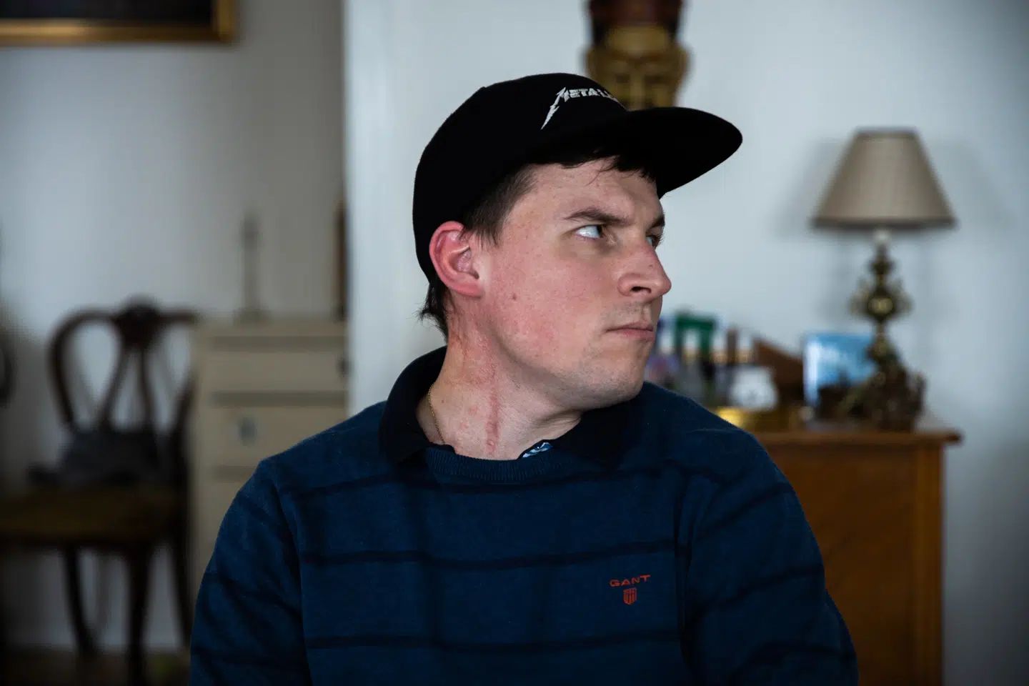 Benjamin Andresen har fået transplanteret venen, der går hele vejen fra kravebenet og op til hjernen. Nu sidder der en blodåre fra låret bag det lange ar.