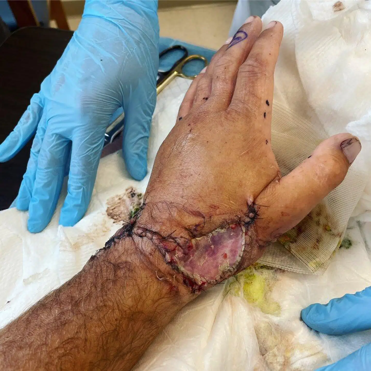 Sean McInerneys hånd efter ulykken.