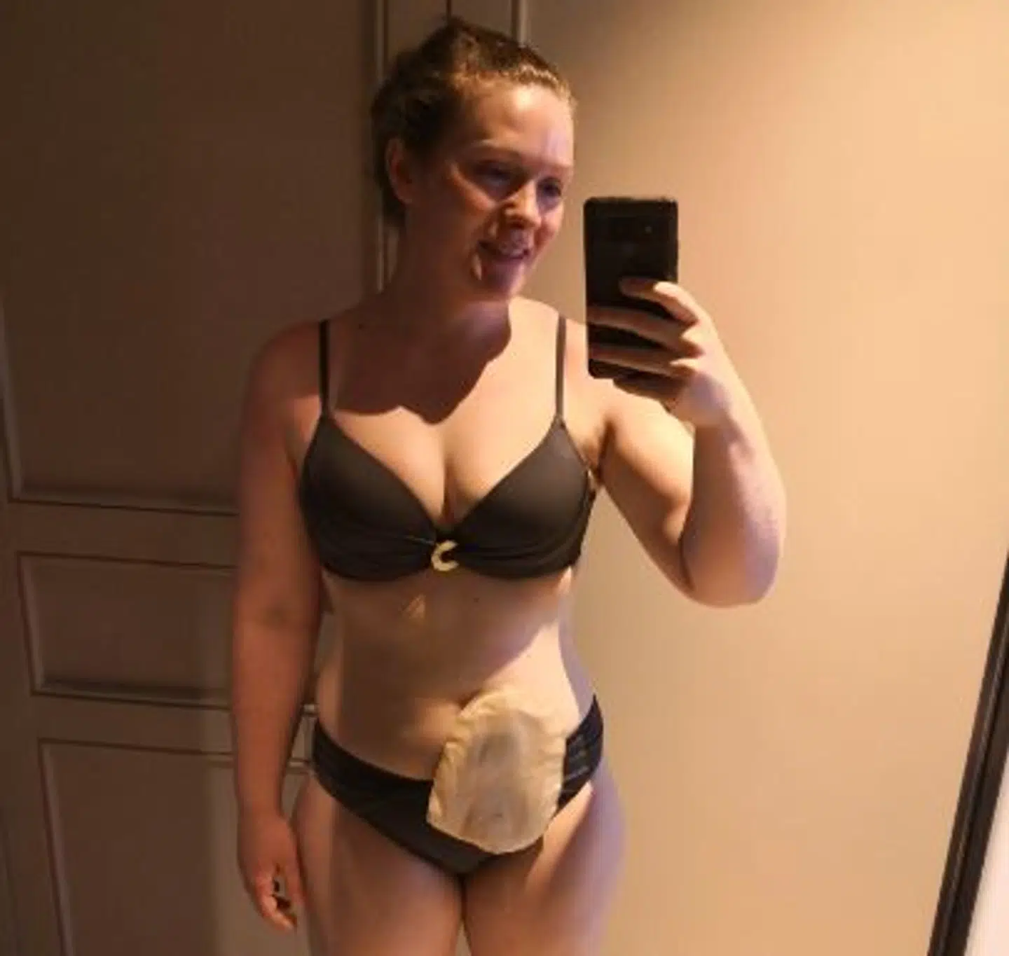 Mathilde med sin stomi-pose (Privatfoto)