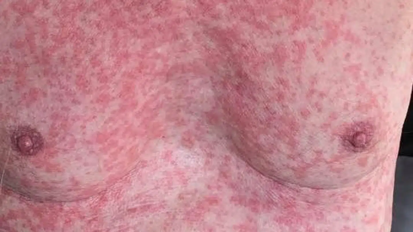 Maybritts 76-årige far, efter han blev vaccineret. (Privatfoto)