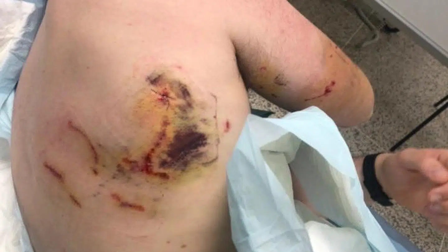 Jens Jakob Uhrenholt viser her nogle af de skader, som geparden har givet ham.