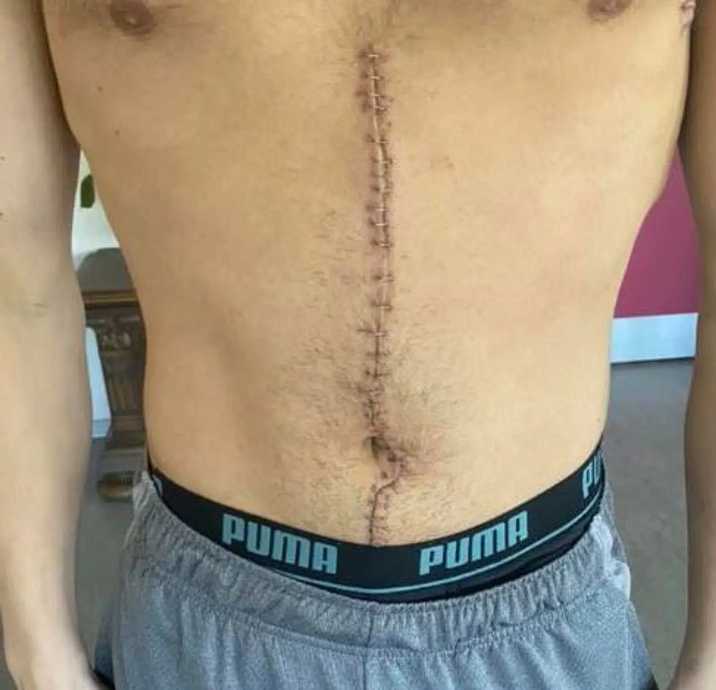 Lægerne måtte skære offerets maveregion op for at behandle hans omfattende og livstruende skader. (Privatfoto)