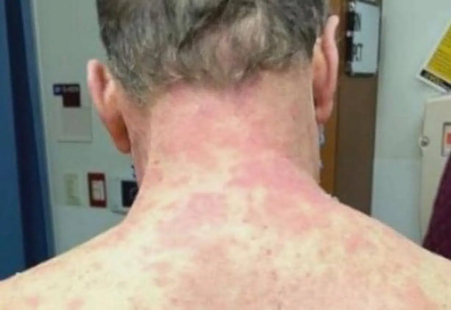 Udslættet, som manden fik. Foto: Picture: Dr. FNU Nutan, VDU Medical Center.