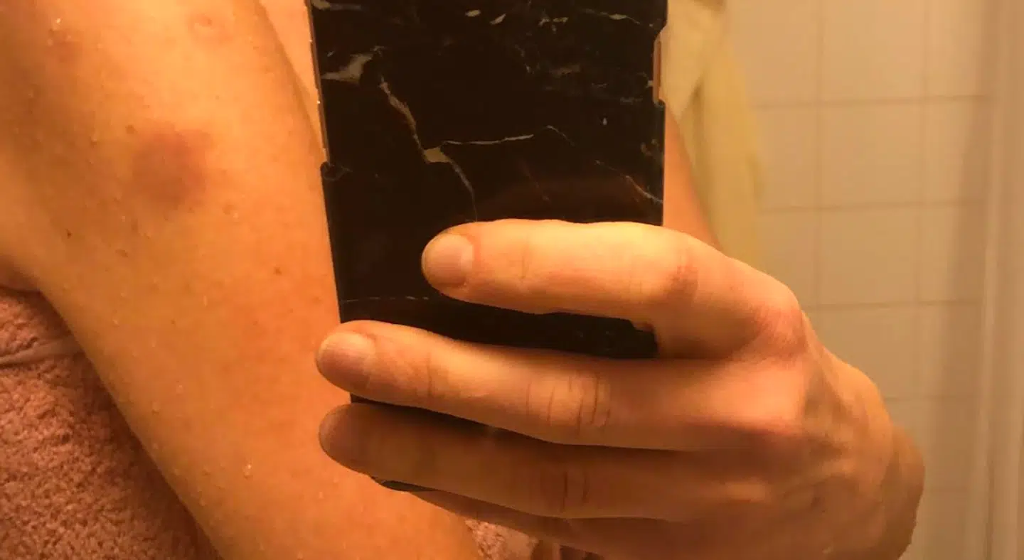 Et billede af et blåt mærke efter vaccination, som en B.T.-læser har sendt.