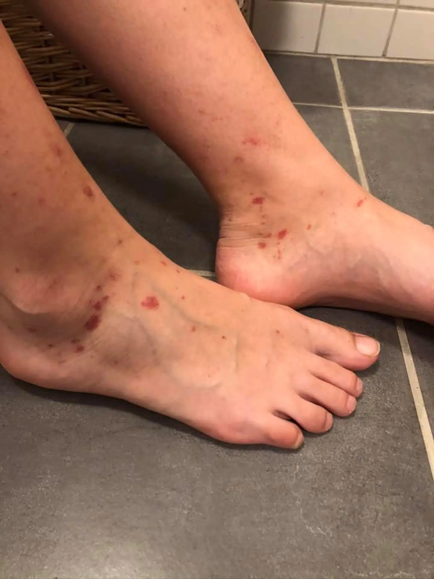 Sådan så Frejas ben og fødder ud efter coronavirussen