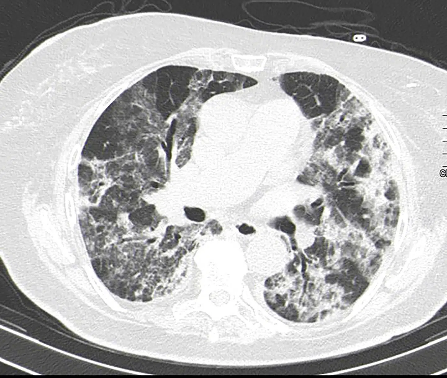 En CT-scanning af en 84-årig coronapatients lunger. Covid-19 påvirker ikke bare lungerne, men også kroppens andre organer, herunder hjernen. Forskere i hele verden arbejder på at finde ud af, hvordan og hvor længe. Courtesy of Havelhoehe Community Hospital/Handout via REUTERS