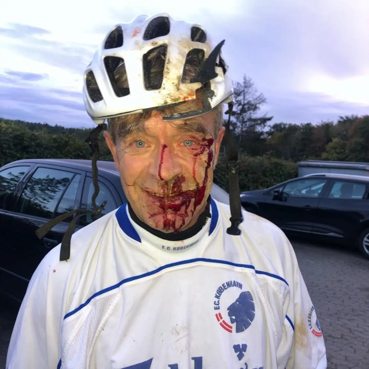 Michael Brammer flækkede læbben og brækkede nakken, da han væltede på sin mountainbike onsdag.