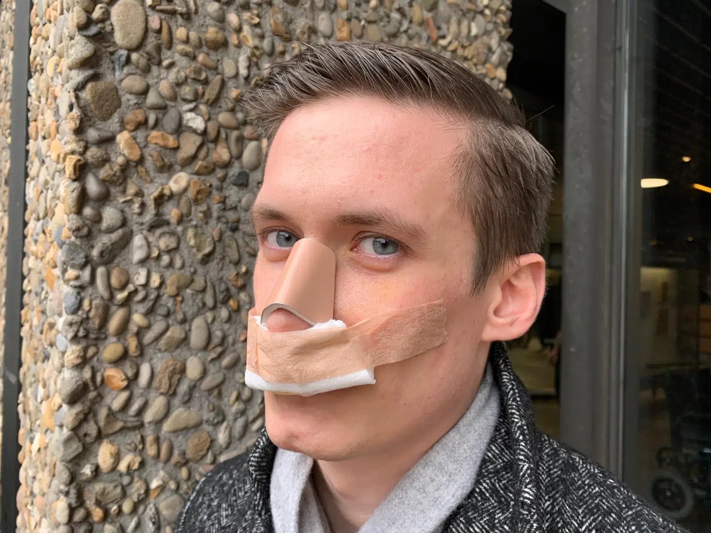 25-årige Lasse Leisner på Rigshospitalet, efter han har fået sat sin næse på plads.