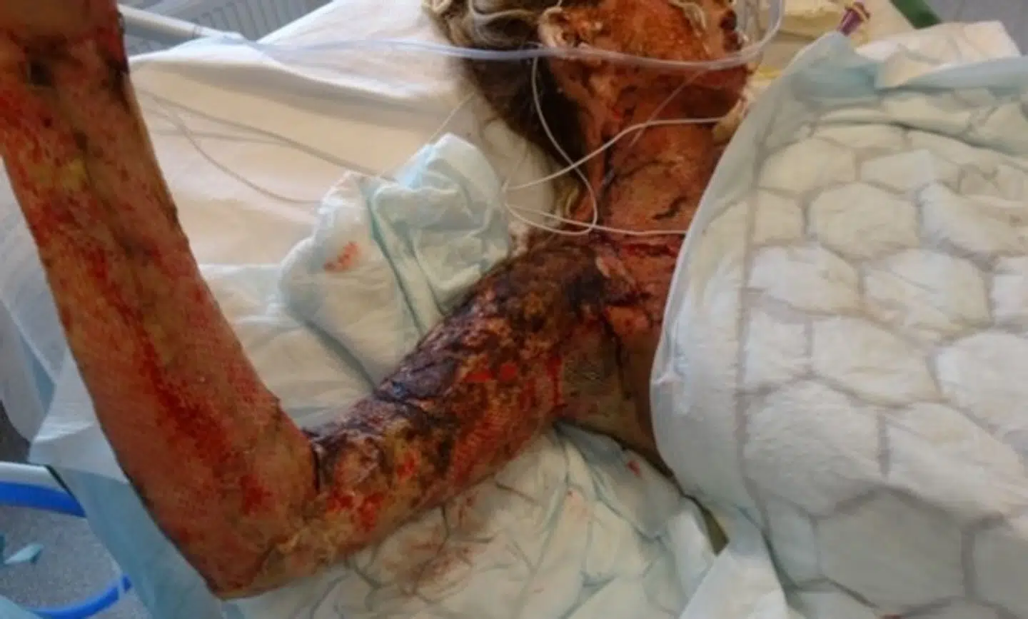 Carolina Özguns arm var skadet i et omfang, så længere overvejede at amputere den ved skulderen.