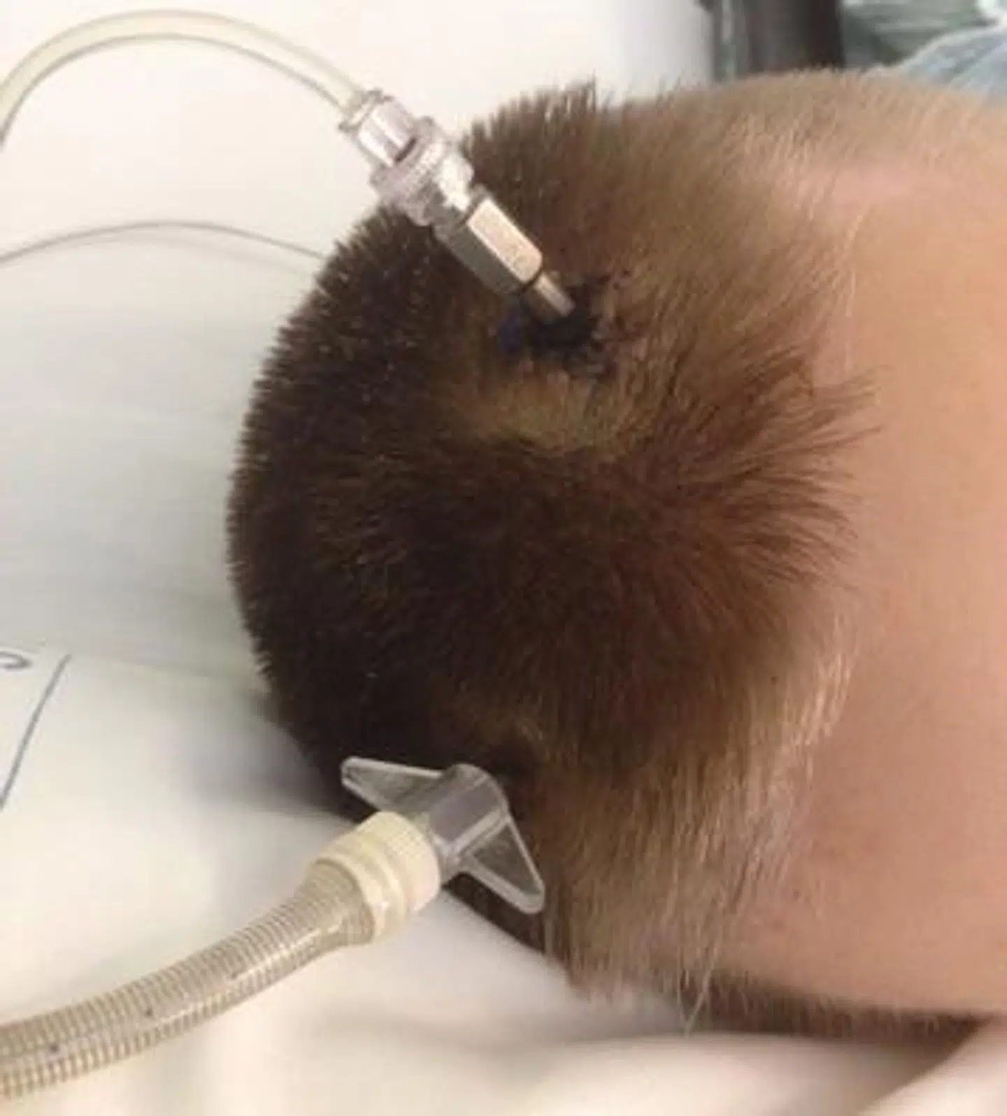 Phillip fik drænet sit hoved for væske og blod efter ulykken. Foto: Privat.