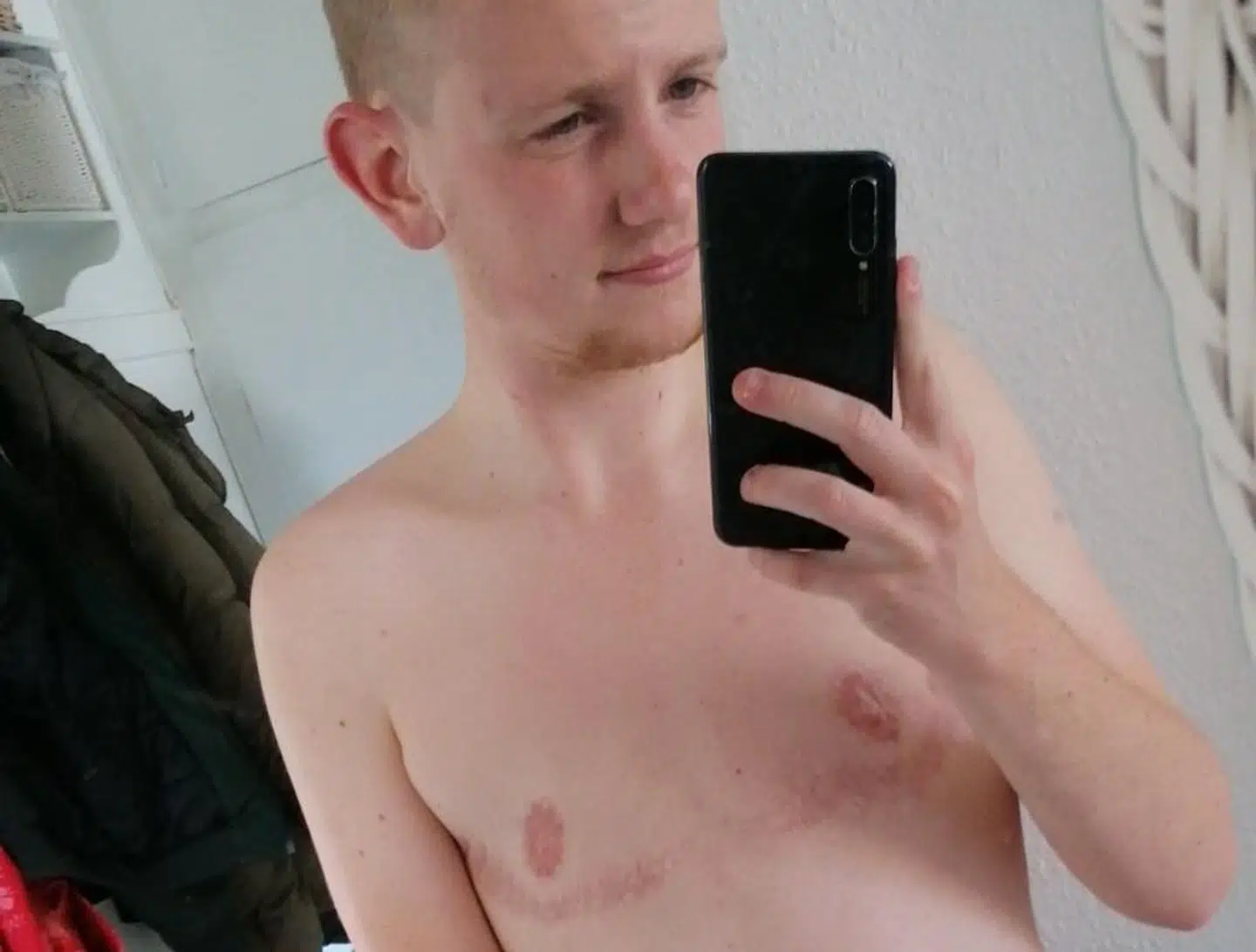 Xander Grønne har i dag store ar undr brystmusklerne og ar rundt om sine brystvorter, da der blav lavet nye vorter ud fra hans oprindelige. Foto: Privat