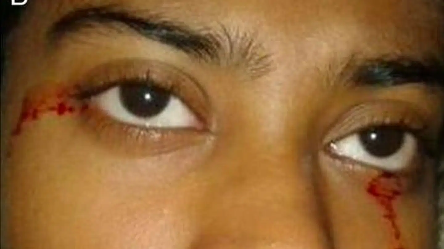 Lægerne kan ikke finde nogen forklaring på, hvorfor den 11-årige pige græder blod.