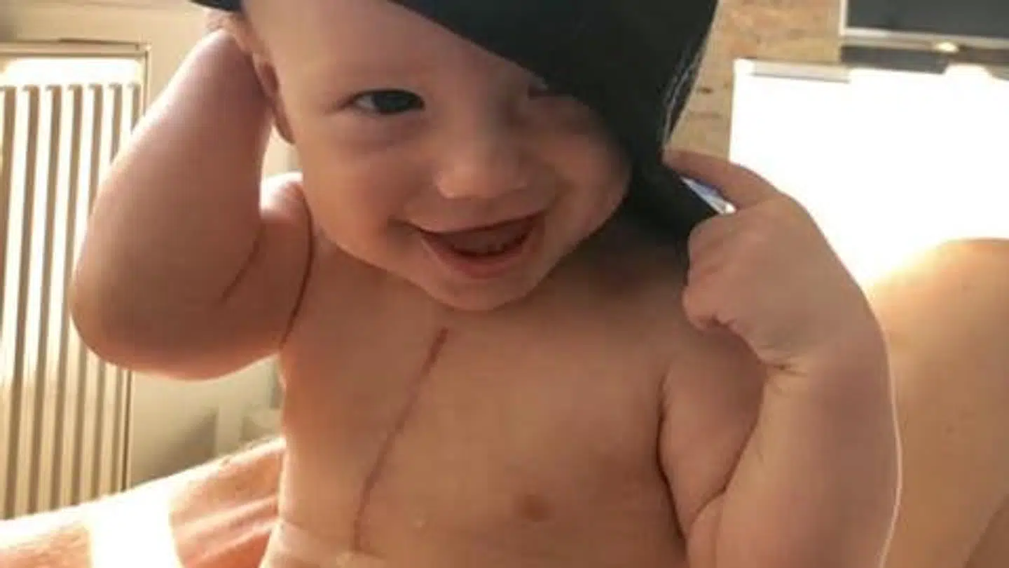 Hugo vil altid have et ar, hvor lægerne har opereret ham. Foto: Privat.