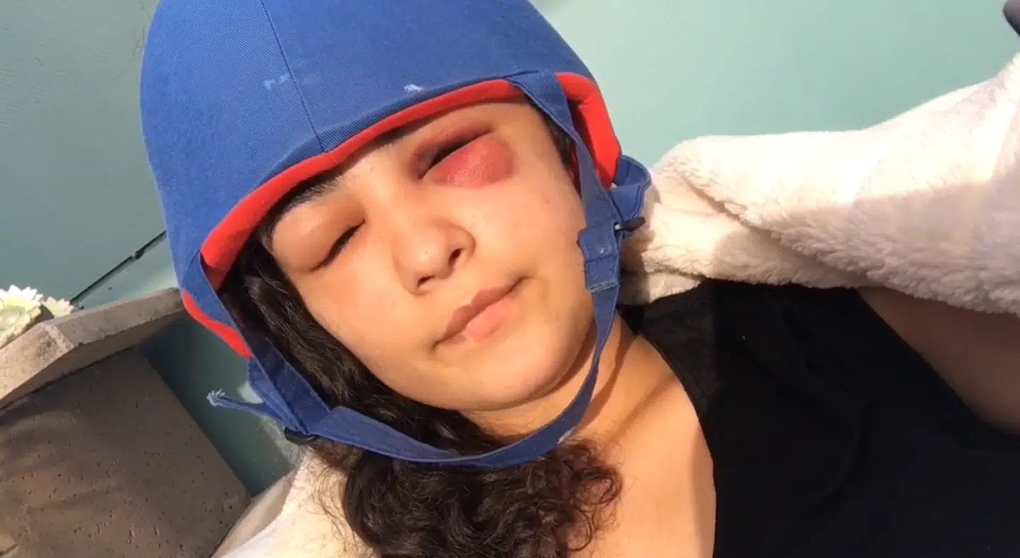 Efter Sibel Cetin havde fået fjernet et stykke af sit kranium, måtte hun havde skumhjelm på for at beskytte sin hjerne.