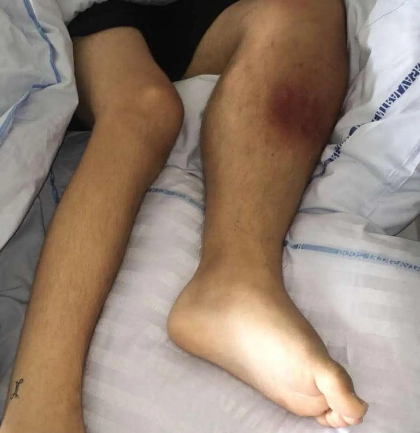 Rasmus' ben er hævet og gør ondt, da han beslutter at opsøge sin praktiserende læge. Det viser sig at være kræft. Foto: Privat.