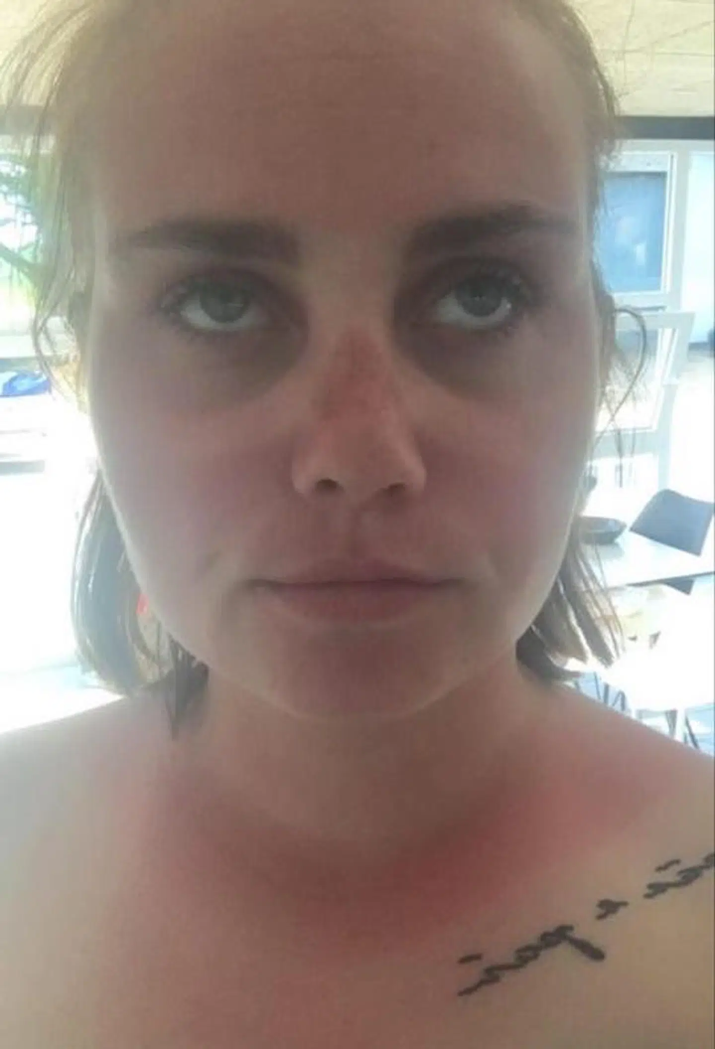 Billede af Marie fra den dag, hvor hun kom hjem og var solbrændt.