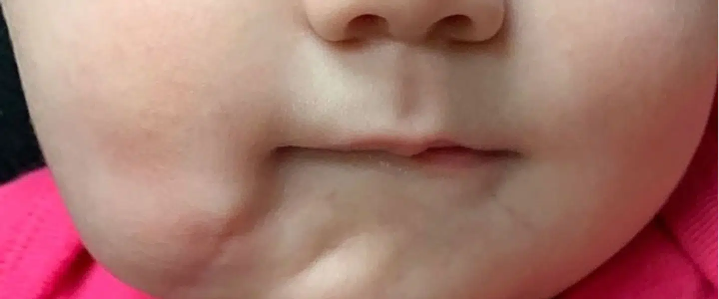 Sådan ser pigen ud efter operationen.