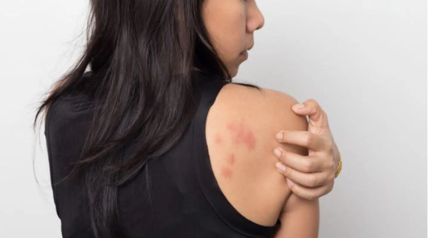 Nye symptomer på coronavirus kan være udslæt og kløe.